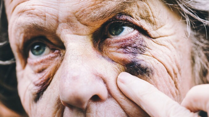 Elderly woman nursing two black eyes after injury