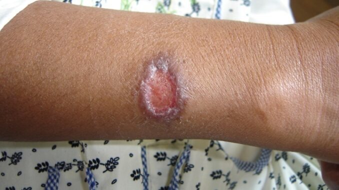 LESMANIASIS